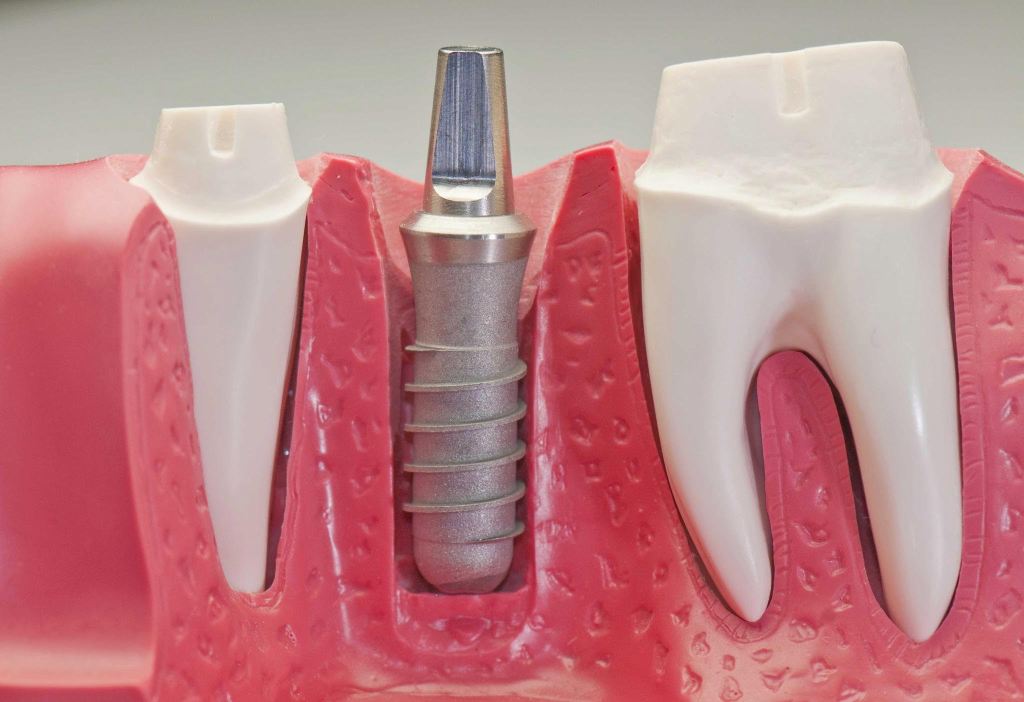 protesi-fissa-dentale