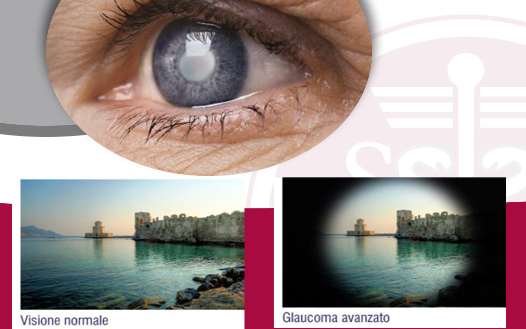 Glaucoma. Difenditi dal “ladro silenzioso della vista”!