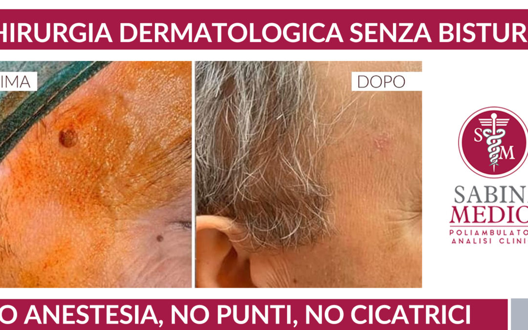 Chirurgia dermatologica senza bisturi? Oggi si può!